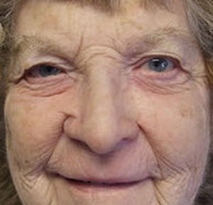 Prótesis estética esterna nasal - Medical Art Prosthetics - para adulto