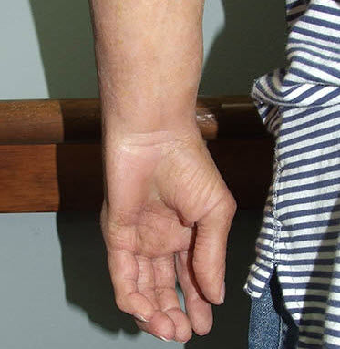 Prótesis estética esterna de mano - Medical Art Prosthetics - para adulto