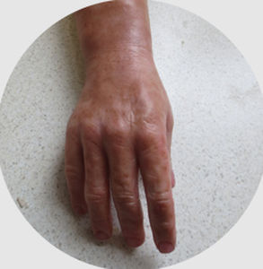 Prótesis estética esterna de mano - myo-electric - Northern Prosthetics - para adulto