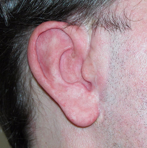 Prótesis estética esterna auricular - Prosthetic Illusions - para adulto