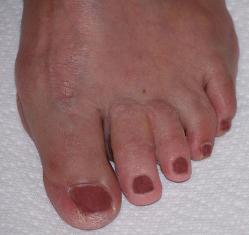 Prótesis estética esterna dedo del pie - Prosthetic Illusions - para adulto