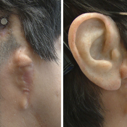 Prótesis estética esterna auricular - Prosthetic Artists - para adulto