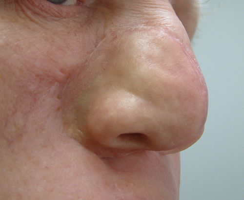 Prótesis estética esterna nasal - Prosthetic Artists - para adulto