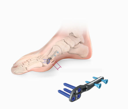 Placa de osteotomía para hallux valgus - Centrolock® - novastep - lateral / bloqueada / metálica