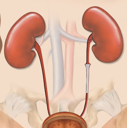 Stent ureteral - Memokath™051 - PNN Medical - de nitinol