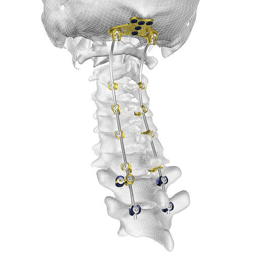 Sistema de osteosíntesis occipitocervicotorácico - TIGER® - Corelink Surgical - vía posterior / para adulto