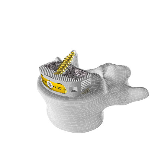 Caja intersomática lumbar - M3 STAND-ALONE ALIF - Corelink Surgical - vía anterior