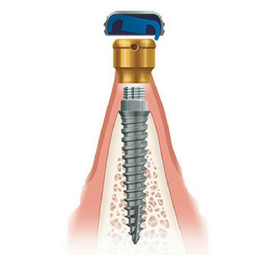 Implante dental de titanio - Zest Dental Solutions - anatómico / estrecho / de anclaje ortodóntico