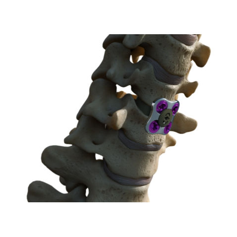 Placa de artrodesis cervical - SETx  - Xenco Medical - metálica / 1 nivel