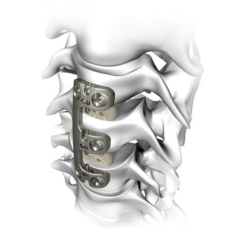 Placa de artrodesis cervical - VERTEVIEW - Atlas Spine - bloqueada / metálica / 2 niveles