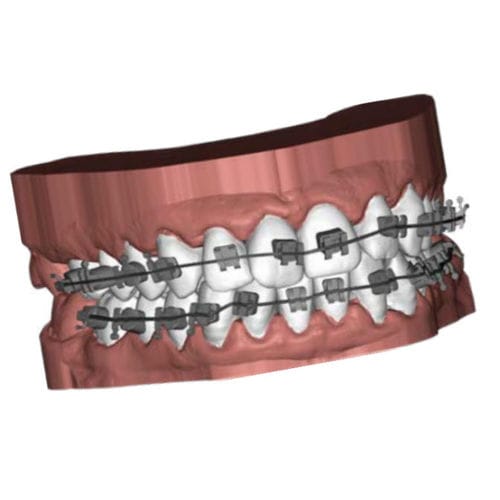 Software de CAD - Ubrackets - Coruo - de impresión 3D / ortodóntico / Windows
