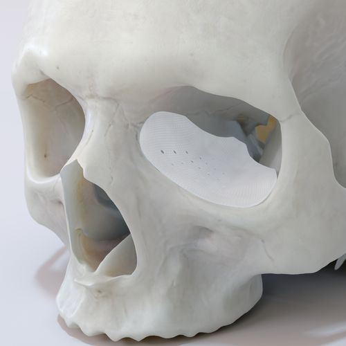 Implante periorbital a medida - TnR series - T&R Biofab - reabsorbible