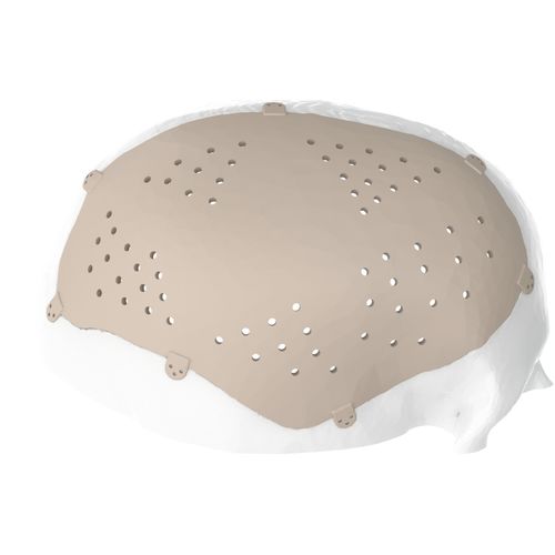 Implante craneal a medida - Kune Implants