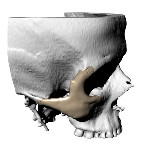 Implante periorbital a medida - Kune Implants - no reabsorbible