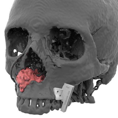 Plantilla de resección para la reconstrucción maxilofacial - Kune Implants