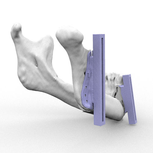 Plantilla de resección para la reconstrucción maxilofacial - RMP - Kune Implants
