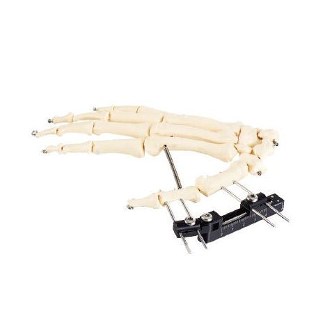 Fijador externo para articulación metacarpofalángica - Wuhan Yijiabao Biological Materials - tubular / para adulto