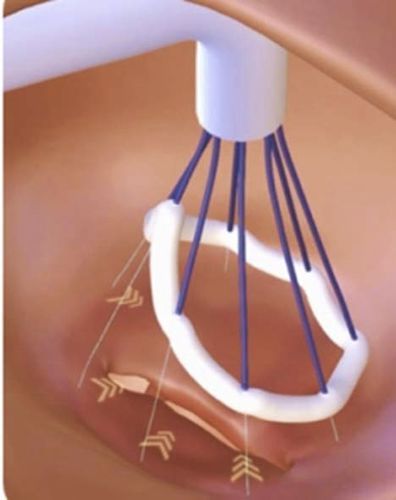 Sistema de reparación cardiaca válvula mitral - Valfix Medical - válvula tricúspide