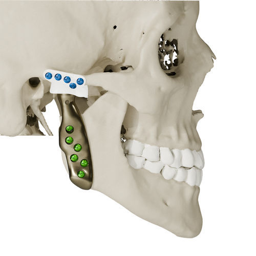 Implante temporomandibular a medida - Craniotech