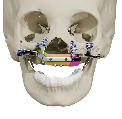 Implante maxilar a medida - Craniotech