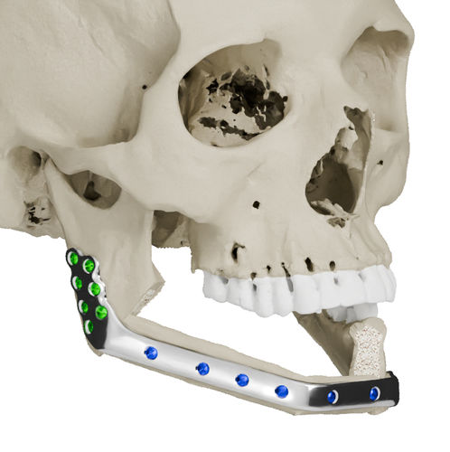 Implante mandibular a medida - Craniotech - no reabsorbible