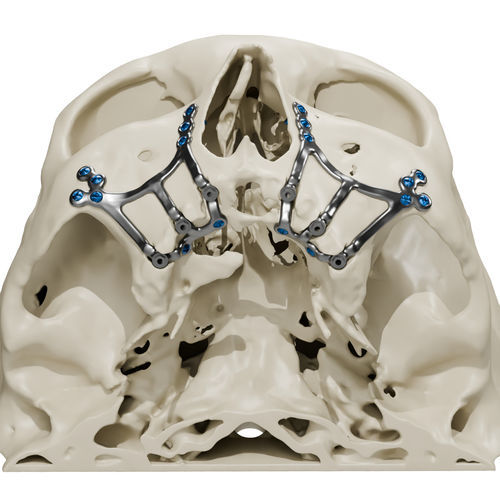 Implante subperióstico a medida - Craniotech - de titanio / anatómico / subperióstico