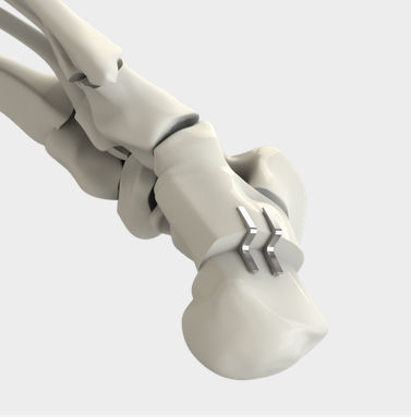 Grapa ortopédica para osteotomía de desplazamiento del calcáneo - DynaFORCE® Step - CrossRoads Extremity Systems - no reabsorbible
