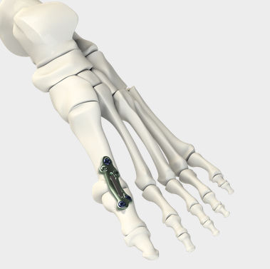 Placa de artrodesis para articulación metatarsofalángica - DynaFORCE® MPJ  - CrossRoads Extremity Systems - metálica