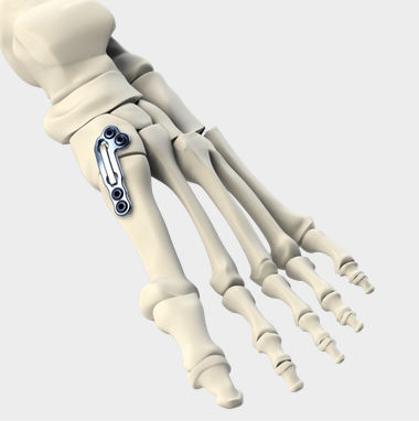 Placa de artrodesis para articulación tarsometatarsiana - LAPIDUS - CrossRoads Extremity Systems - metálica