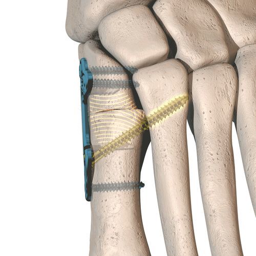 Placa de osteotomía para hallux valgus - dynaBunion® - CrossRoads Extremity Systems