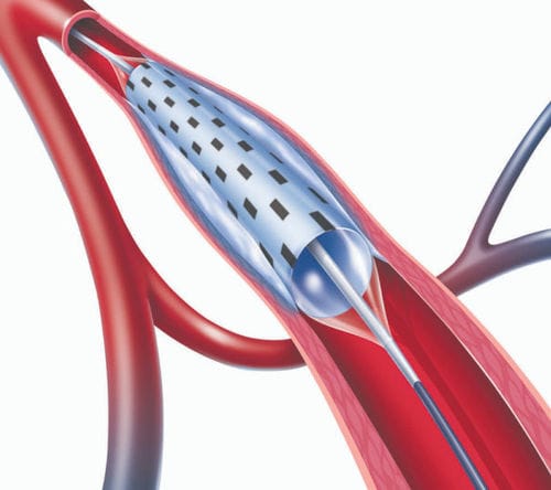 Catéter ATP - PolarCath  - Nucryo Vascular - arteria subpoplítea / arteria femoral / arteria ilíaca