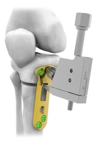 placa de osteotomía para tibia - Astrolabe