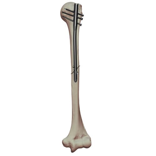 Clavo intramedular para húmero - NUNA - Dunitech - fijación diafisaria / fijación proximal / derecho