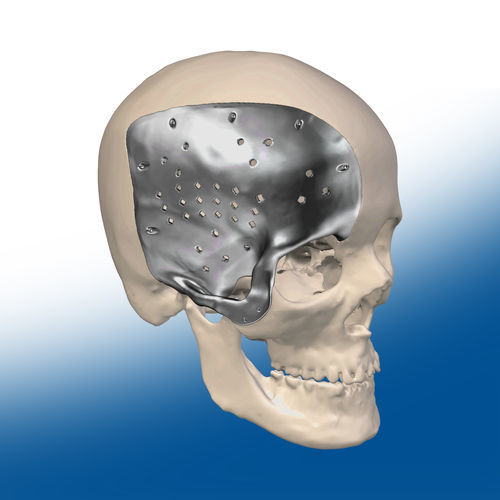 Implante craneal a medida - Ortho Baltic