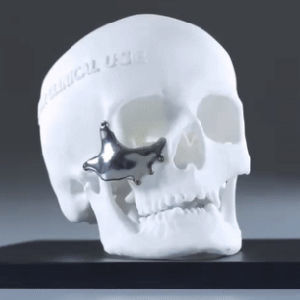 Implante periorbital a medida - Ortho Baltic