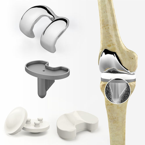 Prótesis de rodilla tricompartimental - Zimed Medical - de deslizamiento con conservación del ligamento cruzado / de platillo móvil / cementada