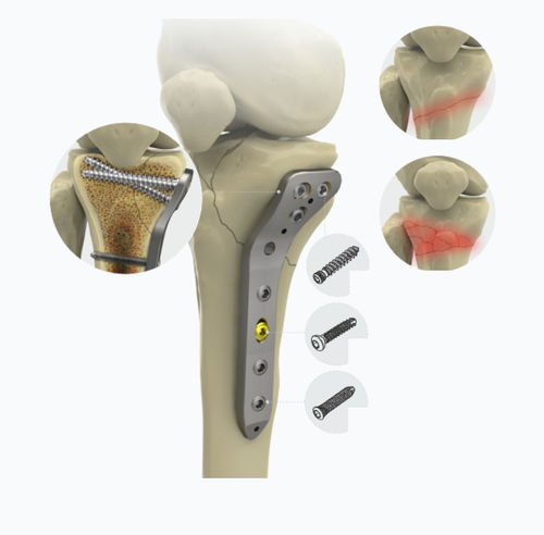 Placa de compresión porción proximal - 1572 series - Zimed Medical - para tibia / porción medial / bloqueada