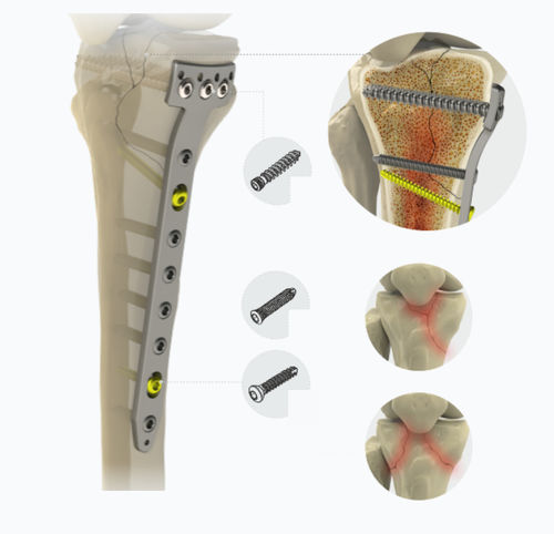 Placa de compresión porción proximal - 1792 series - Zimed Medical - para tibia / porción medial / bloqueada