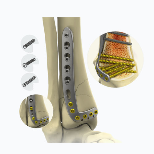 Placa de compresión para tibia - 10132 series - Zimed Medical - porción distal / anterolateral / bloqueada