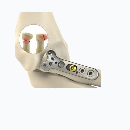 Placa de compresión para radio - 8762 series - Zimed Medical - para cóndilo humeral / porción proximal / bloqueada
