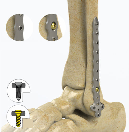 Placa de compresión para peroné - 1852 series - Zimed Medical - porción distal / bloqueada / metálica