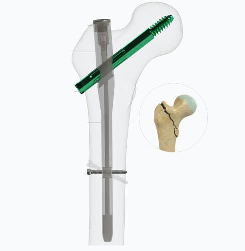 Clavo intramedular para fémur - Zimed Medical - fijación proximal / metálico