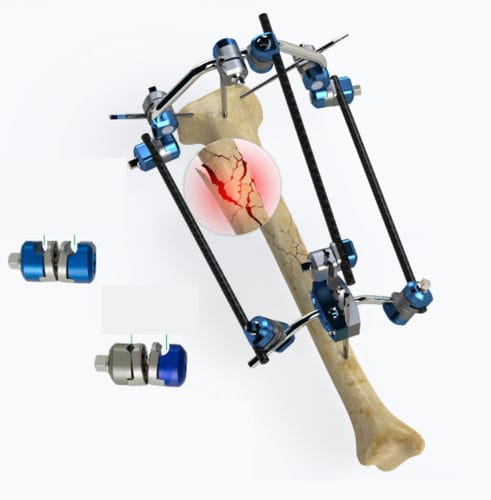 Fijador externo para tibia - Zimed Medical - tubular / para adulto