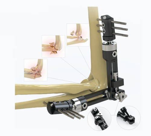 Fijador externo para codo - 5934-0000 - Zimed Medical - tubular / para adulto