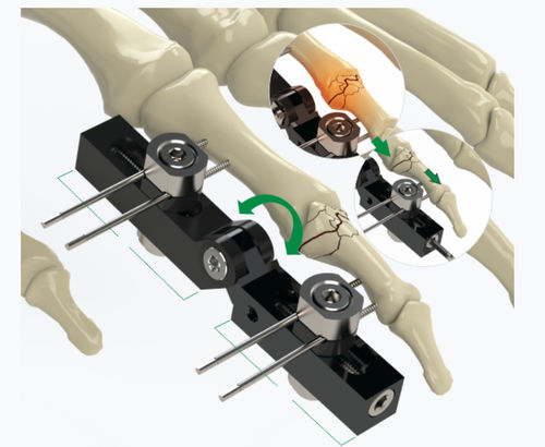 Fijador externo para articulación metacarpofalángica - 5084-0000 - Zimed Medical - tubular / para adulto