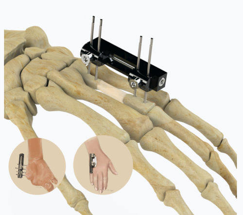 Fijador externo para articulación metacarpofalángica - 5084 series - Zimed Medical - tubular / para adulto