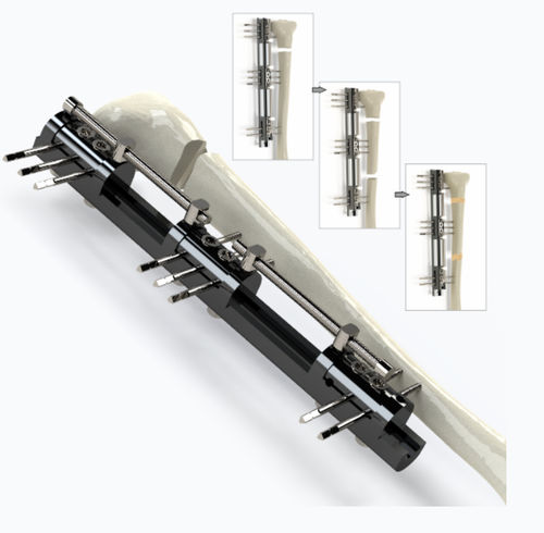 Fijador externo para tibia - 5074 series - Zimed Medical - tubular / para adulto