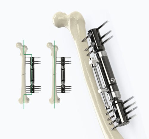 Fijador externo para tibia - 5014 series - Zimed Medical - para fémur / tubular / para adulto
