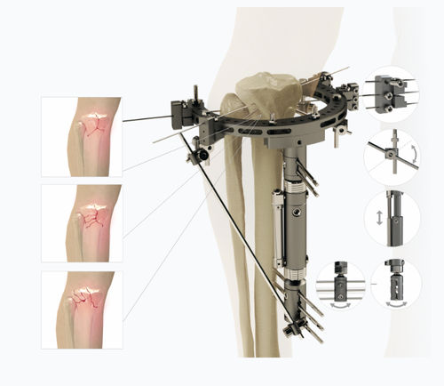Fijador externo para tibia - 5254 series - Zimed Medical - para fémur / híbrido / para adulto