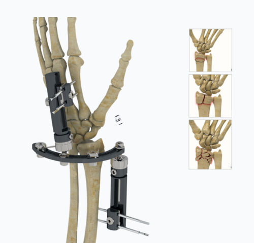 Fijador externo para muñeca - 5134-0000  - Zimed Medical - híbrido / para adulto